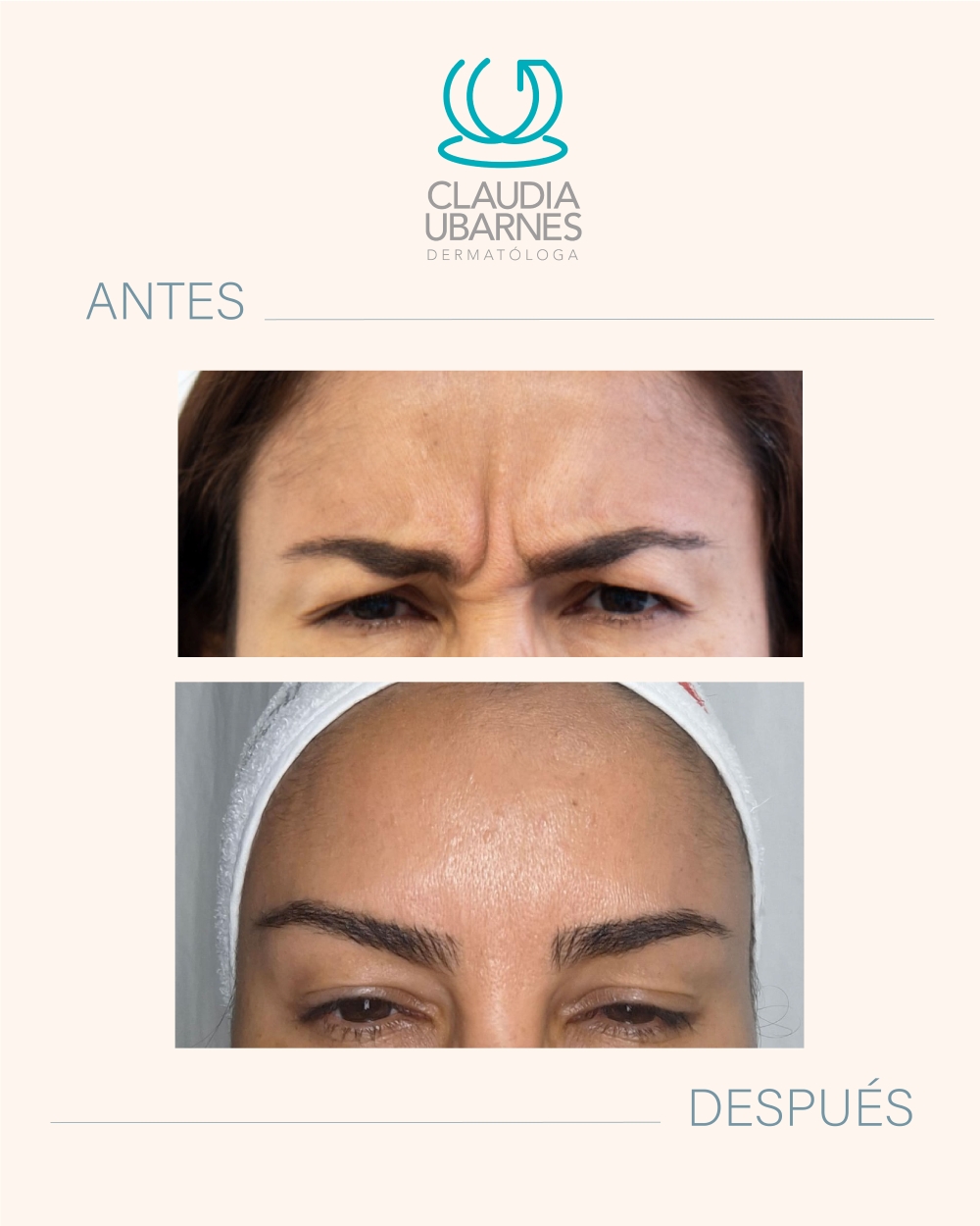 Dra. Caludia Ubarnes Dermatologa Caso de exito antes y despues 3